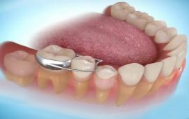 Bộ giữ khoảng cho răng là gì?